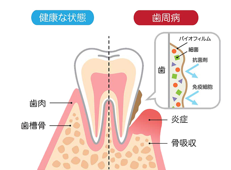 歯の健康な状態と歯周病の状態を比較した説明図。左側は正常な歯肉と歯槽骨を示し、右側は歯周病により歯肉が炎症(腫れ)を起こし、歯槽骨が骨吸収によって減少している様子を描いています。また、右上の拡大図では、歯の表面に付着したバイオフィルム(細菌の膜)が、抗菌剤や免疫細胞の攻撃を阻んでいる仕組みが示されています。