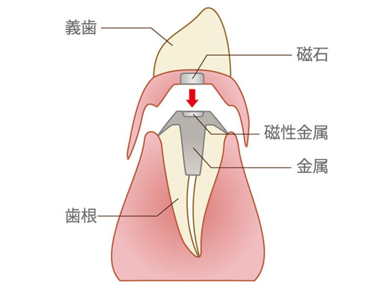 磁性アタッチメント義歯(磁石式入れ歯)の仕組みを示す断面図。残った歯根に「磁性金属」を組み込み、入れ歯(義歯)側に「磁石」を取り付けることで、磁力によって入れ歯を固定する構造が解説されています。